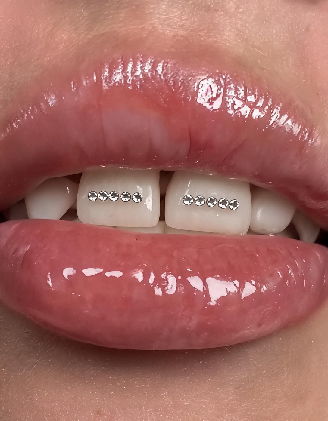 Même sourire, bijou dentaire posé